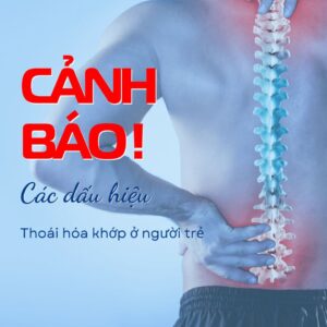 Dấu hiệu thoái hóa khớp ở người trẻ
