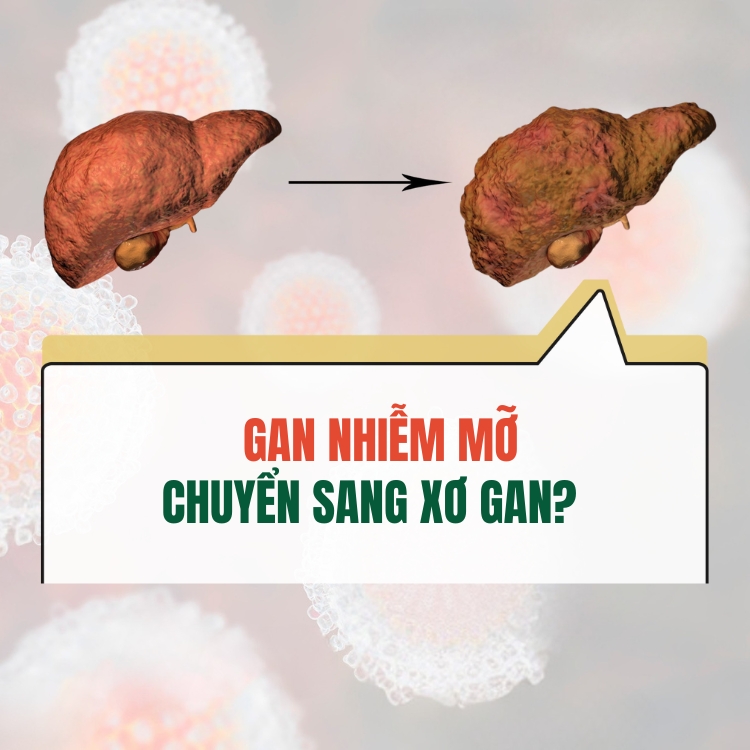 Dau Hieu Gan Nhiem Mo Chuyen Sang Xo Gan Can Luu Y Ngay 683143d4ce2a4.webp