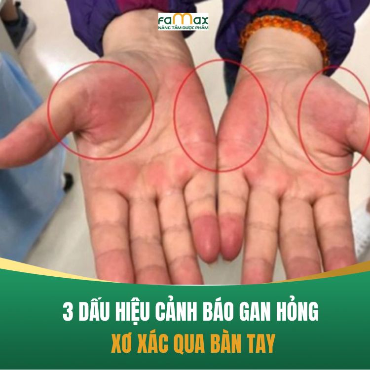 3 Dau Hieu Canh Bao Gan Hong Qua Ban Tay 68dd029eb45f4.webp