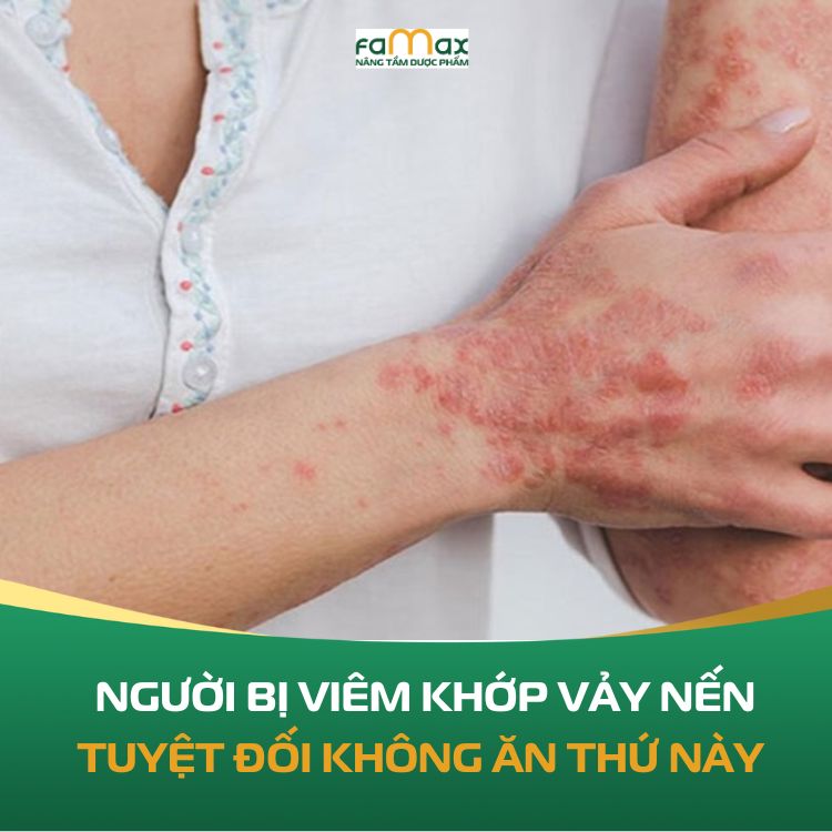 Bi Viem Khop Vay Nen Khong An Thu Nay 68e72edccbf83.webp