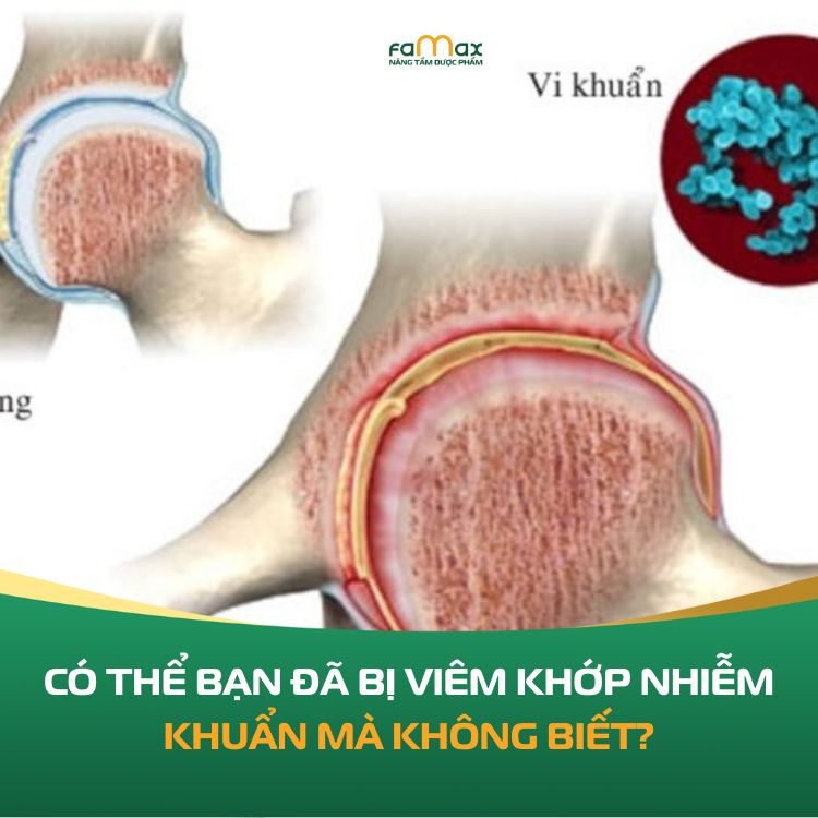 Co The Ban Da Bi Viem Khop Nhiem Khuan Ma Khong Biet 69046bf166221.webp