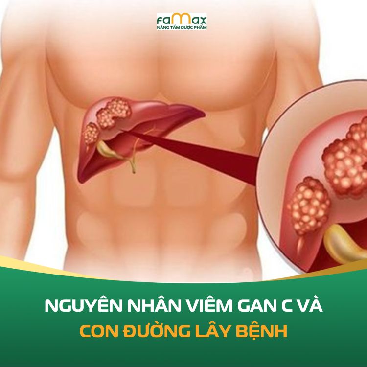 Nguyen Nhan Viem Gan C Va Con Duong Lay Benh Biet De Phong Ngua 68ef298210faa.webp