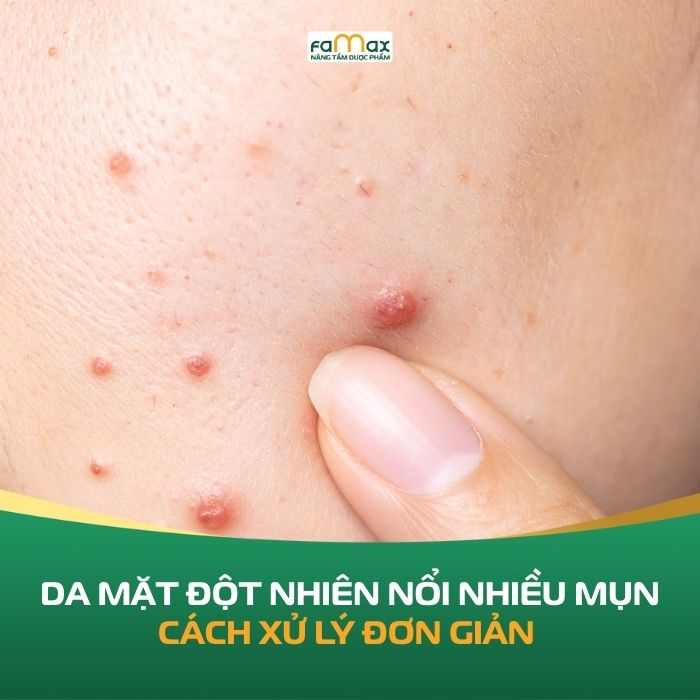 Da Mat Dot Nhien Noi Nhieu Mun Nguyen Nhan 69671f7e66cd6.webp